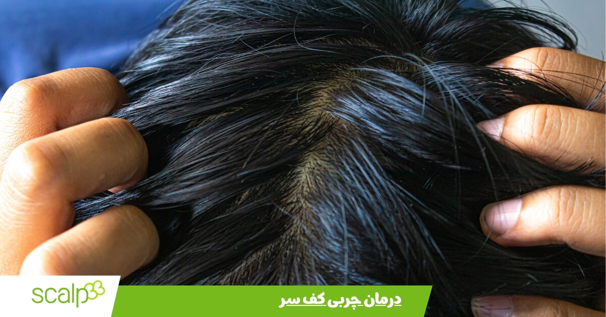 درمان چربی کف سر 