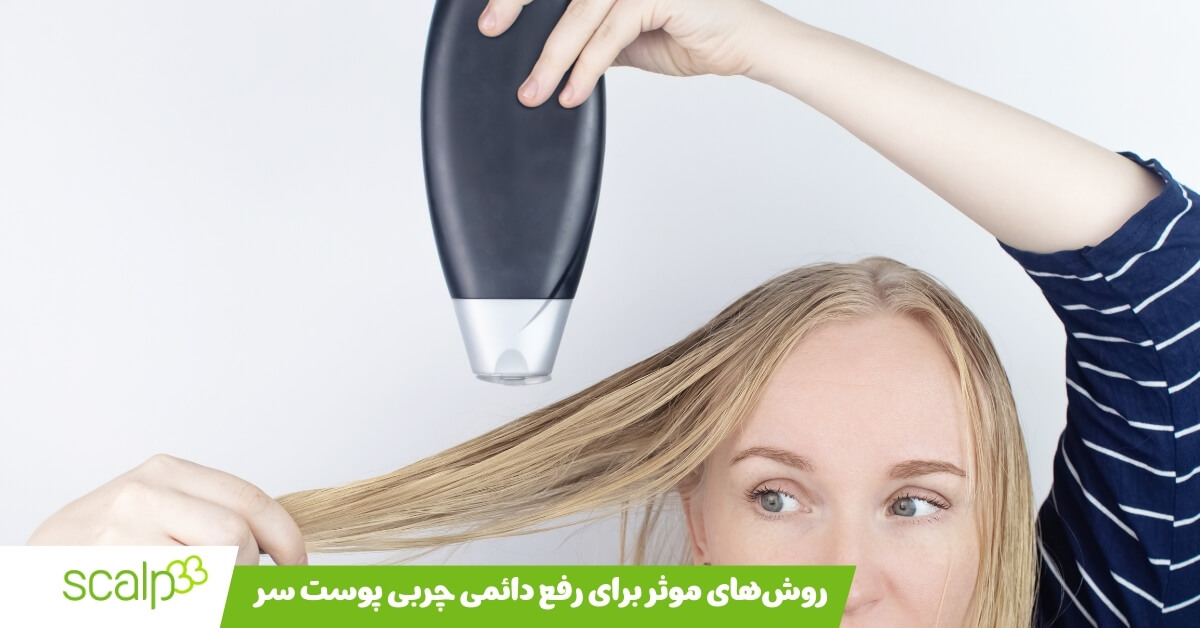 درمان چربی کف سر 