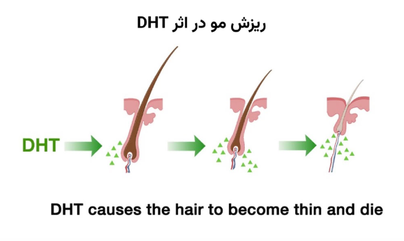 ‎تغییرات هورمونی موثر در ریزش مو جوانان