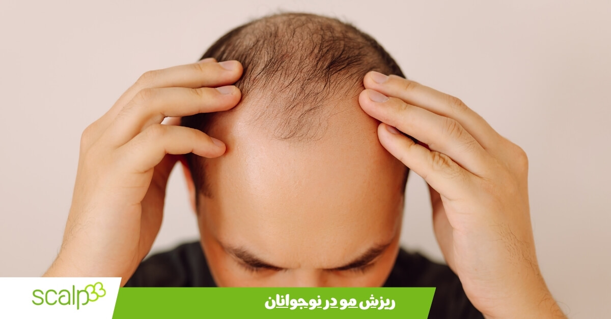 بررسی ریزش مو در نوجوانان