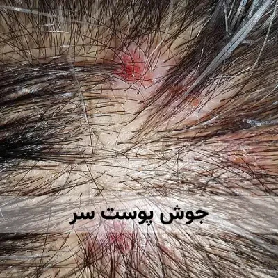 چرا پوست سر جوش میزند