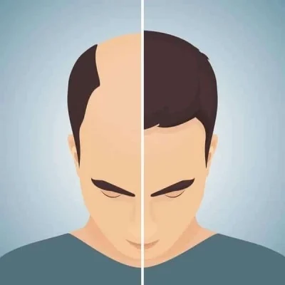 ریزش مو ارثی