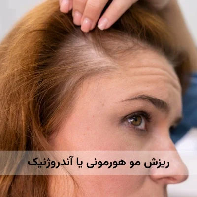درمان ریزش مو هورمونی