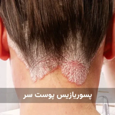بیماری پسوریازیس پوست سر